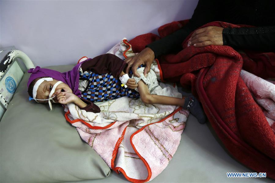YEMEN-SANAA-CHILDREN-MALNUTRITION