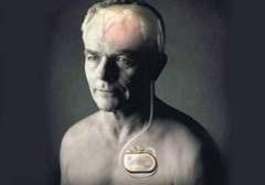 起搏器真的能治好帕金森病嗎？